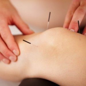 Acupuncture North Adelaide